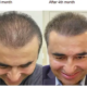The Quiet Reset What the Weeks After a Hair Transplant Are Really Like