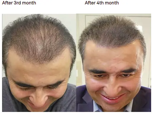 The Quiet Reset What the Weeks After a Hair Transplant Are Really Like